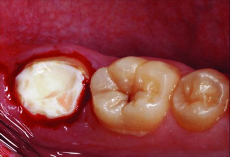 Preparation performed on the mandibular second molar. | Download ...