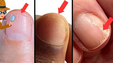 How To Survive Splitting Nails Causes And Remedies Youtube