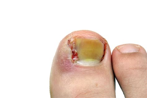 Ingrown Toenail Procedures Ottawa Foot Clinic