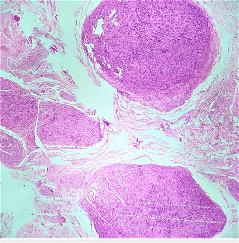 Tumor Cells Arranged In Multiple Nodules Of Varying Sizes With A Very