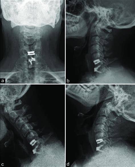 Postoperative X Ray Of Patient With Hybrid Fixation Anteriorposterior Download Scientific