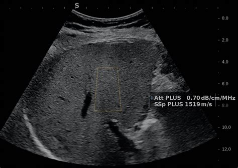 Noninvasive Assessment Of Liver Steatosis With Ultrasound Techniques Radiology Key