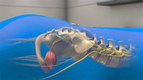 Neuspera Sacral Neuromodulation System For Urinary Urgency Incontinence Uui 3d Animation