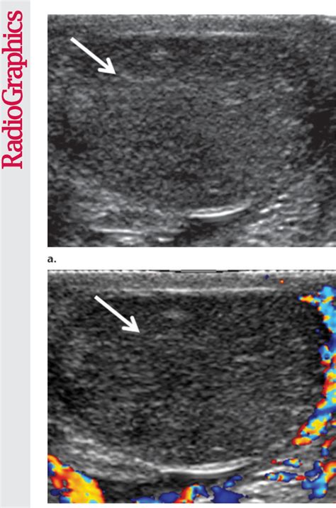 Figure 7 From Testicular Tumors What Radiologists Need To Know