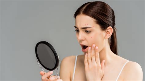 Jawline Acne Know The Causes And How To Treat It Healthshots