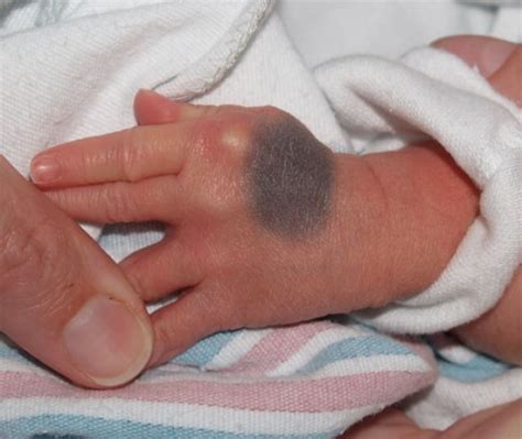 Neonatal Nevus