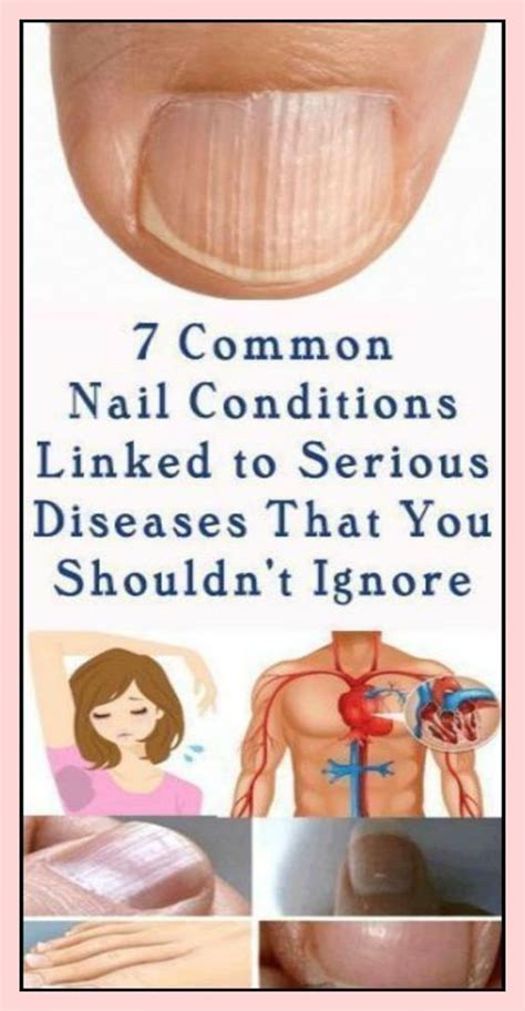 7 Common Nail Conditions Linked To Serious Diseases That You Shouldn’t Ignore Red Nail Beds