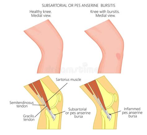 Subsartorial O Bursitis De La Anserina Del Pes De La Rodilla