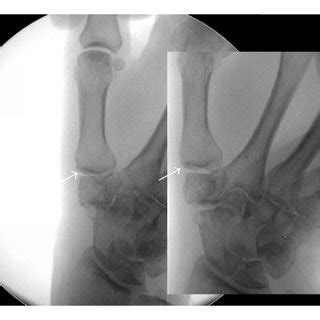 A Anteroposterior And Lateral X Rays Of The Right TMC Joint Of A