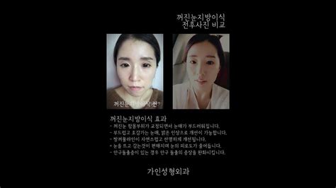 푹 꺼진눈지방이식 전후 6주차까지 Youtube