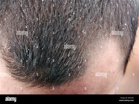 Dandruff in the hair. Symptoms of skin disease Stock Photo - Alamy