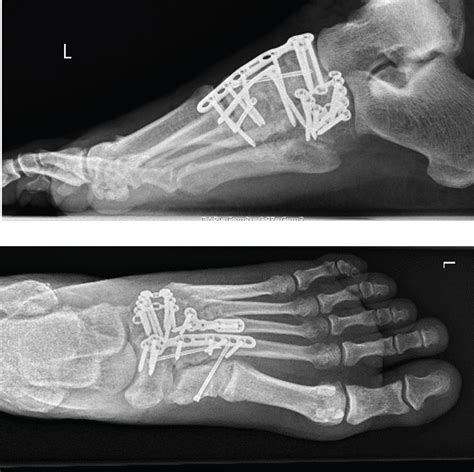 Lisfranc Injury