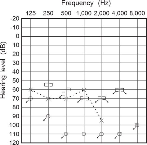 Pure Tone Audiogram Shows Profound And Severe Sensorineural Hearing