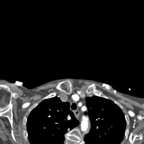 Fileacute Right Mca Infarct Meningioma And Retinal Detachment Ct