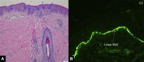 Epidermolysis Bullosa Acquisita Histology