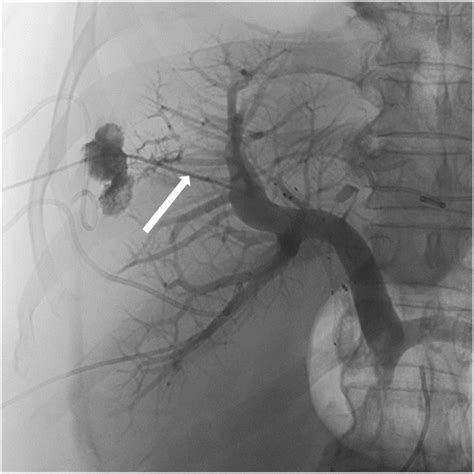 Portal Vein Embolization In The Treatment Of Portal Vein Bleeding After