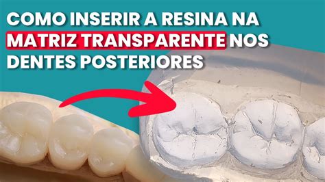 DENTE POSTERIOR EM RESINA COMPOSTA SEM ESCULTURA Mylene E Renato YouTube