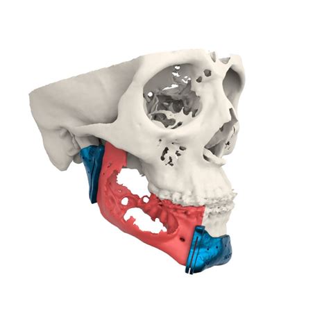 Reconstrucci N Mandibular Planificaci N De Precisi N Con Colgajo