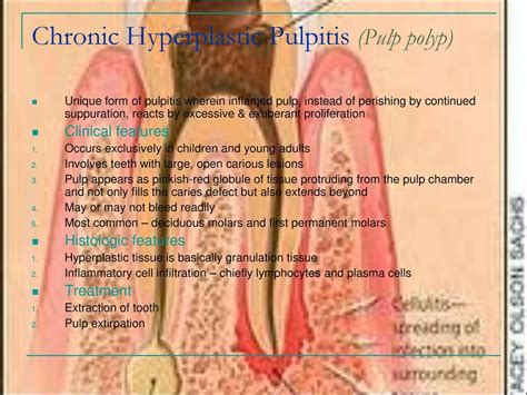 Diseases Of Pulp And Periapical Tissues Ppt Download