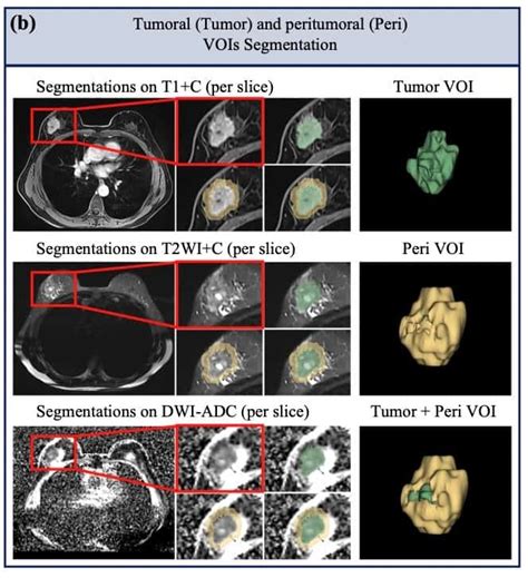 A Noninvasive Tool Based On Magnetic Resonance Imaging Radiomics For