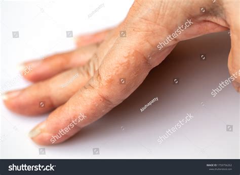 Close Atopic Dermatitis On Fingerad Known Stock Photo