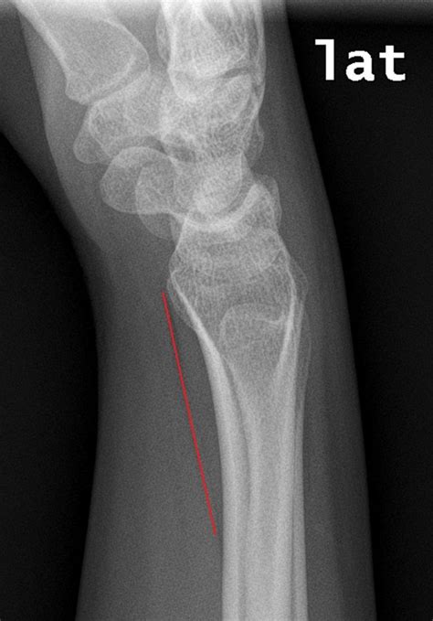 Pronator Quadratus Sign Resus