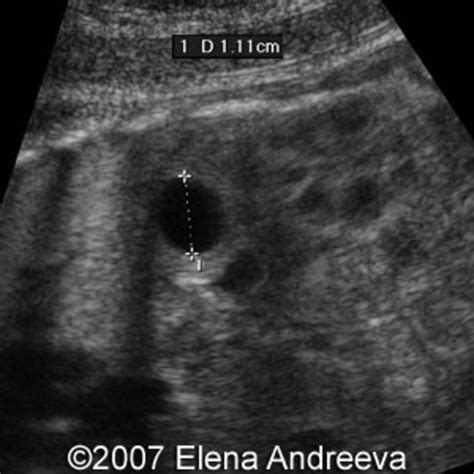 📃 Splenic Cyst