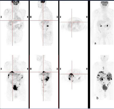 Pet Ct Maximum Intensity Projection Mip Images In A Patient With