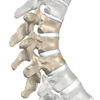 Scheuermann's Disease - eOrthopod.com