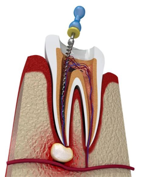 Endodoncia Clínica Dental Seoane Pampín