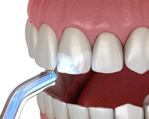 Teeth Bonding What To Expect Dental Bonding Cost