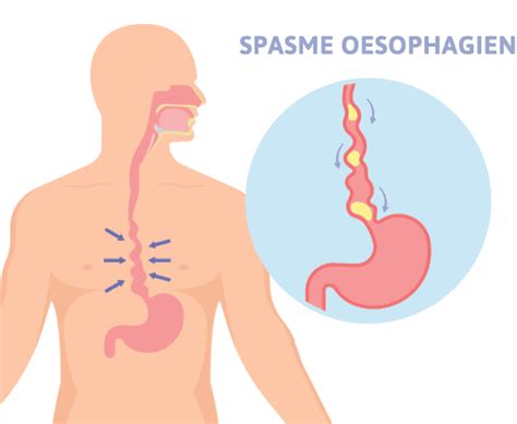 Spasme Oesophagien Description Causes Sympt Mes Traitement Reflux