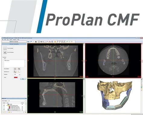 Virtual Surgical Planning Software Depuy Synthes