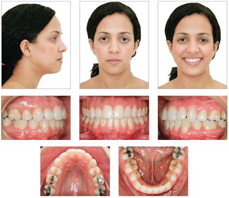 Scielo Brasil Tooth Extractions In Orthodontics First Or Second