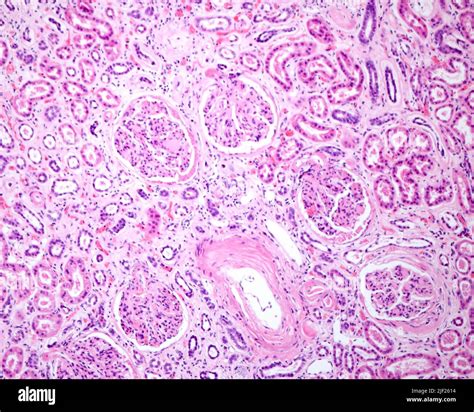 Light Micrograph Of A Human Kidney Affected By An Advanced Diabetic