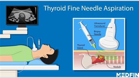 Thyroid Diagnosis Treatment And Recovery Explained