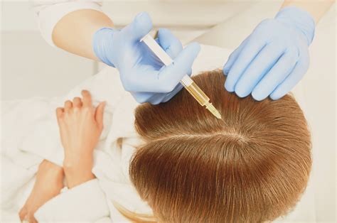 Platelet Rich Plasma Prp Hair Loss Treatment Near Me