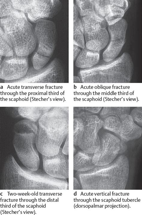 Scaphoid Tubercle