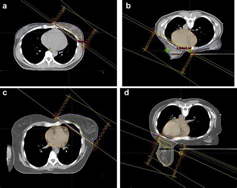 A Prospective Trial To Compare Deep Inspiratory Breath Hold With Prone