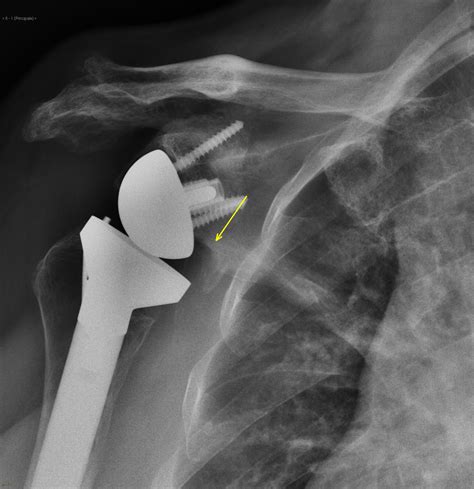 Top 98 Pictures Pictures Of Shoulder Replacement Scars Completed