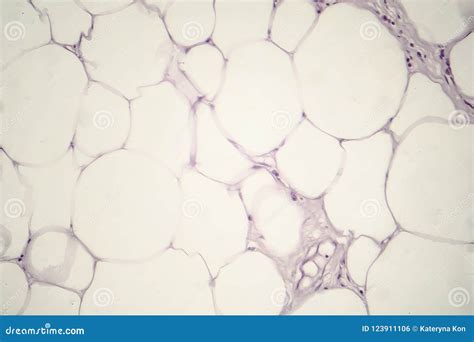 Lipoma, Benign Growth of Fatty Tissue Stock Photo - Image of medical ...