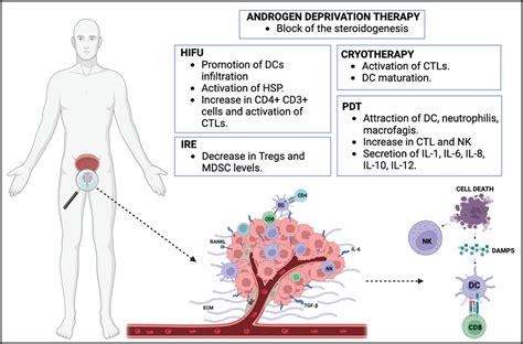 Focal Therapy The Role Of The Tumor Microenvironment In Prostate Cancer