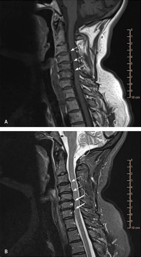 Degenerative Cervical Myelopathy Recognition And Management Aafp