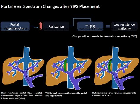 Transjugular Intrahepatic Portosystemic Shunt Ultrasound Evaluation