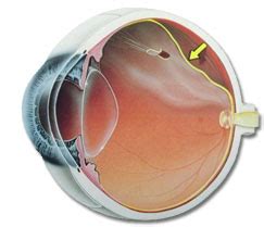 Cirurgia de descolamento de Retina em Curitiba o que é tratamento e