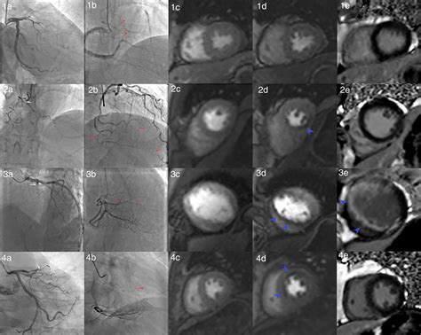 Assessment Of Myocardial Viability And Risk Stratification In Coronary