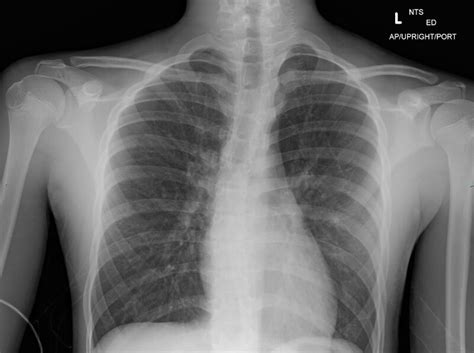 Figure Asthma Radiography This Chest X Ray Shows Increased