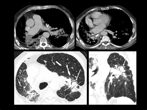 Stage IV Pulmonary Sarcoidosis In A 62 Year Old Man Thoracic CT