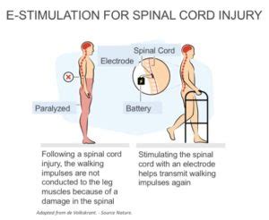 walking with a spinal cord injury e stim - endParalysis foundation ...