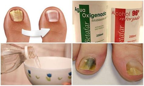 Cómo Eliminar Los Hongos De Las Uñas De Forma Rápida Y Eficaz Soluciones Caseras Remedios